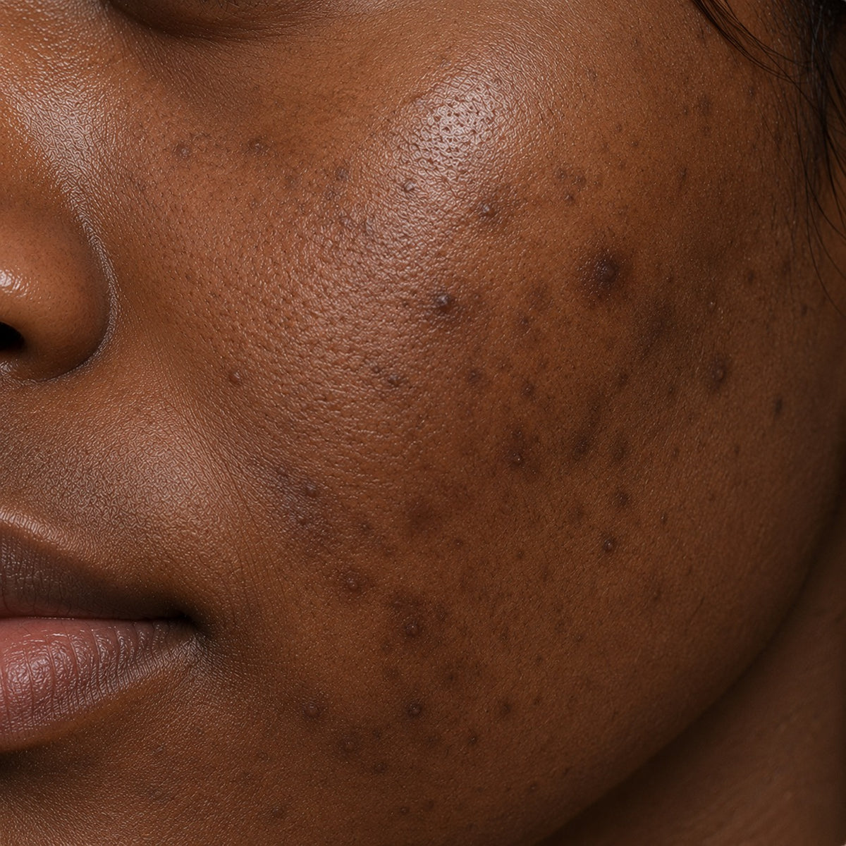 Dark Spots & Pigmentation